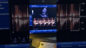 Практическое занятие 1. Определение давления в легочной артерии (Ерошенко О.Л.)