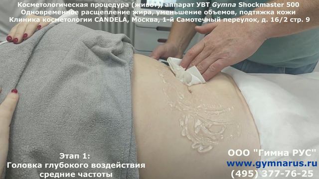 Gymna Shockmaster (Шокмастер) 500: УВТ в косметологии и эстетике. Работа по животу.