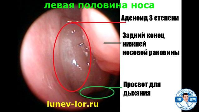 Искривление перегородки носа ИЛИ Аденоид. Что мешает дышать?