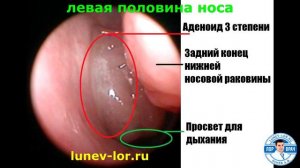Искривление перегородки носа ИЛИ Аденоид. Что мешает дышать?