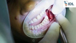 Живая операция, установка имплантов IDL