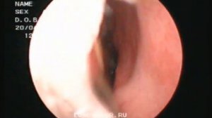 лазерная деструкция нижних носовых раковин