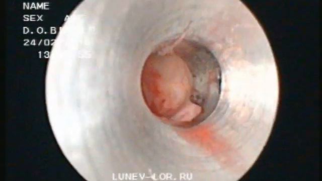 Микрогайморотомия удаление кисты верхнечелюстной пазухи 24022016
