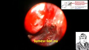 Инфундибулотомия лазерная.  05032018 С