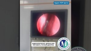 Эндоскопия полости носа.Гнойный синусит.