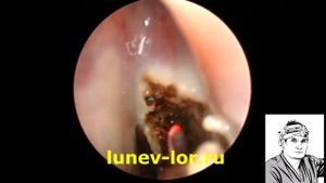 Полип носа, удаление лазером 09022018 с2