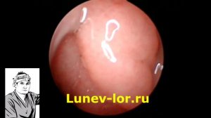 Гипертрофия глоточной миндалины 2-3ст.