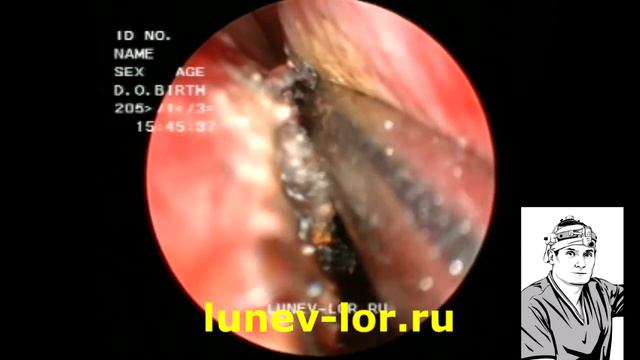 Искривление перегородки носа (операция - лазерная кристотомия) 27012018 с