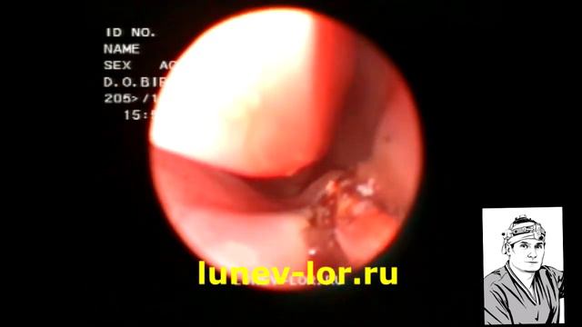 Удаление гребня перегородки носа (Лазерная кристотомия)  27012018 с2