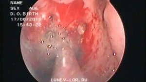 Удаление кисты Торнвальда с помощью лазера и шейвера 170615