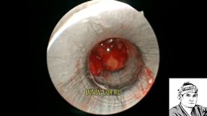 Лазерная инфундибулотомия + Микрогайморотомия 28032018 С