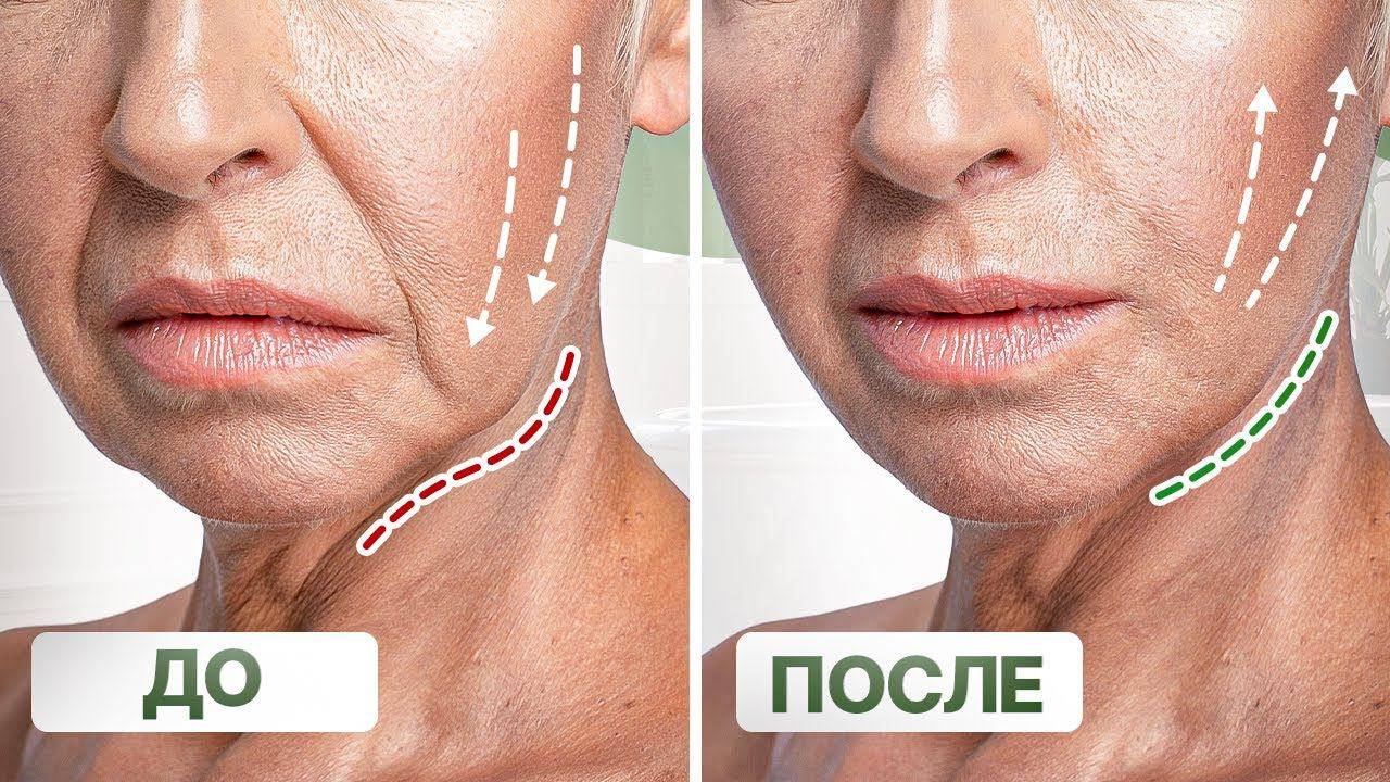 Брыли | Как избавиться от брылей - советы косметолога компании VBG!