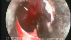 Удаление инородного тела верхнечелюстной пазухи (эндоскопическая часть операции)