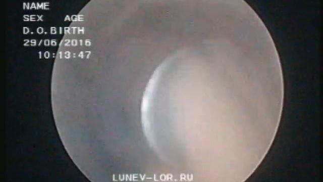 Удаление гребня перегородки носа эндоскопическая лазерная кристотомия 29062016 2