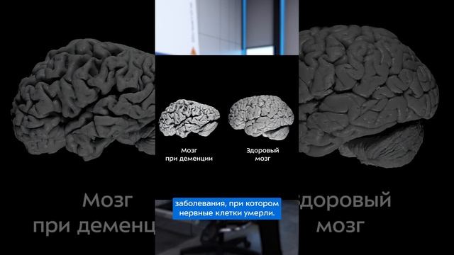 Что такое деменция?  #бауманка #мгту #НОЦ