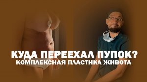 Абдоминопластика с переносом пупка и липосакцией живота и боков