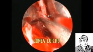 Септопластика, пластика искривленной перегородки носа13042018