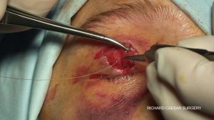 Upper lid primary repair post trauma.