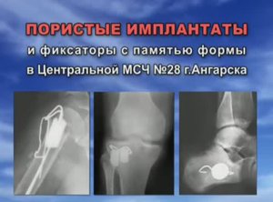 Пористые имплантаты в МСЧ 28 г Ангарск