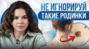 Чем опасны родинки Проверь свои прямо сейчас! НЕ ИГНОРИРУЙ ТАКИЕ РОДИНКИ_ver_2