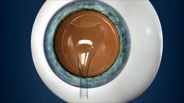 Факичные линзы смотреть онлайн