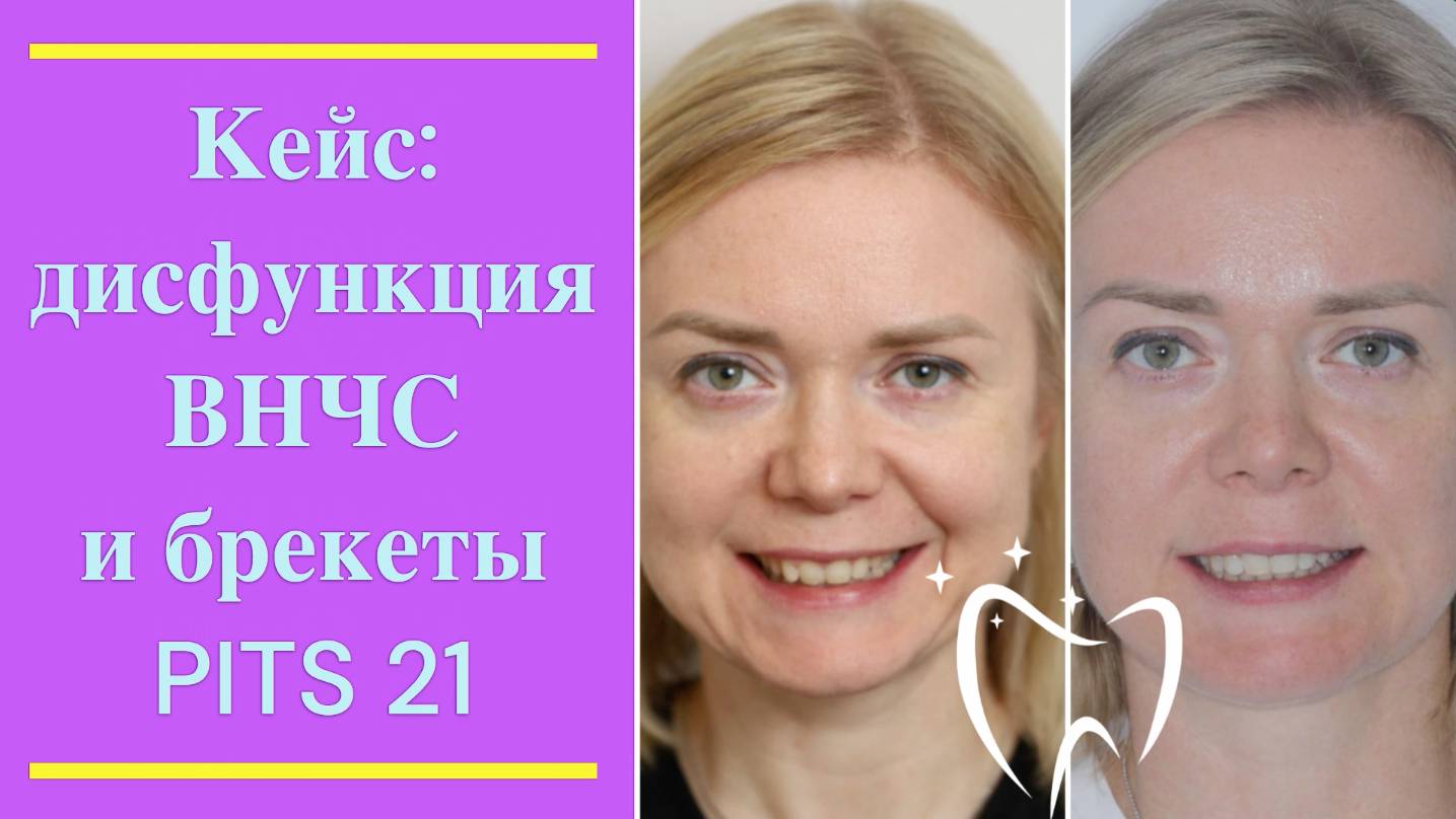 💎 Кейс: дисфункция ВНЧС, сплинтерапия  и брекет-система PITS 21