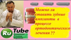 Имплант 13.Можно ли ставить зуб-е импланты в процессе ортодонтического лечения?#имплант#имплантация