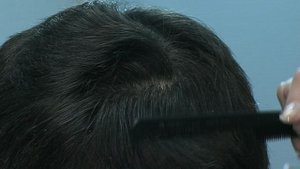 Облысение// 27.12.2008г.