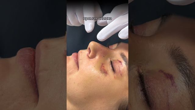 9 дней после пластики верхних век, височного лифтинга и ринопластики.