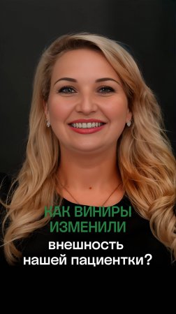 👸🏼 Виниры изменили внешность пациентки! Керамические виниры.