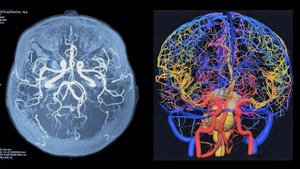 Кровоснабжение головного мозга. Синдромы ишемии в каротидном и вертебрально-базилярном бассейнах.