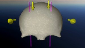 Лобная кость. Дисфункция