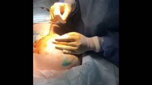 Маммопластика Т- подтяжка