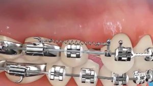 Canine Retraction Springs