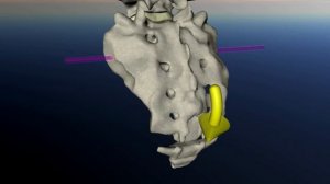 Крестец. Дисфункция