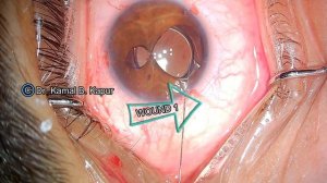 Torrn Pupil repair with single pass four throw technique | Kamal B. Kapur