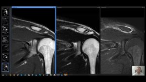 Врач на смене: пример из практики - МРТ плечевого сустава