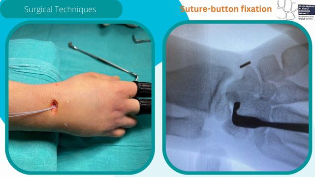 Suture-button Fixation and A Dorsal Capsuloligamentous Repair in Chronic Scapholunate Dissociation смотреть онлайн