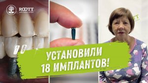 Имплантация при пародонтозе. Отзыв после 11 лет! 🦷🏥