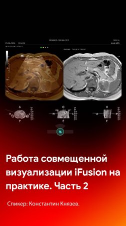 Совмещенная визуализация iFusion на практике. Часть 2