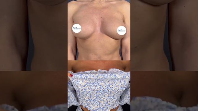МАММОПЛАСТИКА В МОСКВЕ. Запись на консультацию по телефону: +7(985)738-73-20