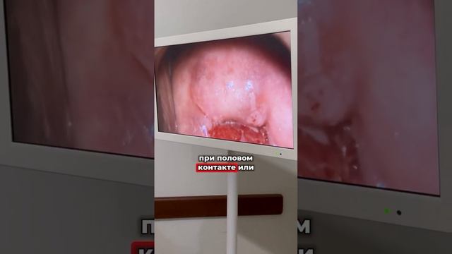 ЧТО ТАКОЕ КОЛЬПОСКОПИЯ И КОМУ ОНА ПОКАЗАНА? Читай описание #здоровье #доктор