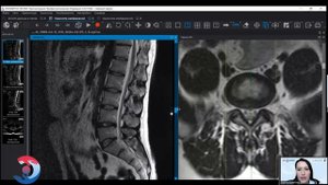 Грыжи диска на МРТ