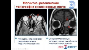 МРТ придаточных пазух носа