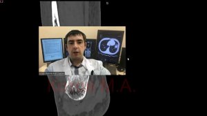 Ложный сустав малоберцовой кости. Ролик №39.