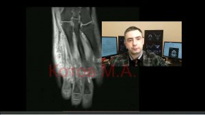 Перелом кубовидной кости. Ролик №15