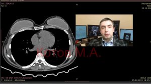 Импланты молочных желез. Норма и разрыв. Ролик №20