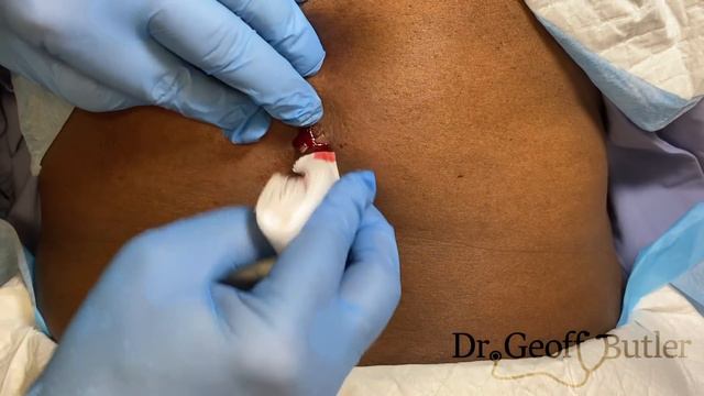 Drainage of an infected cyst on the back смотреть онлайн