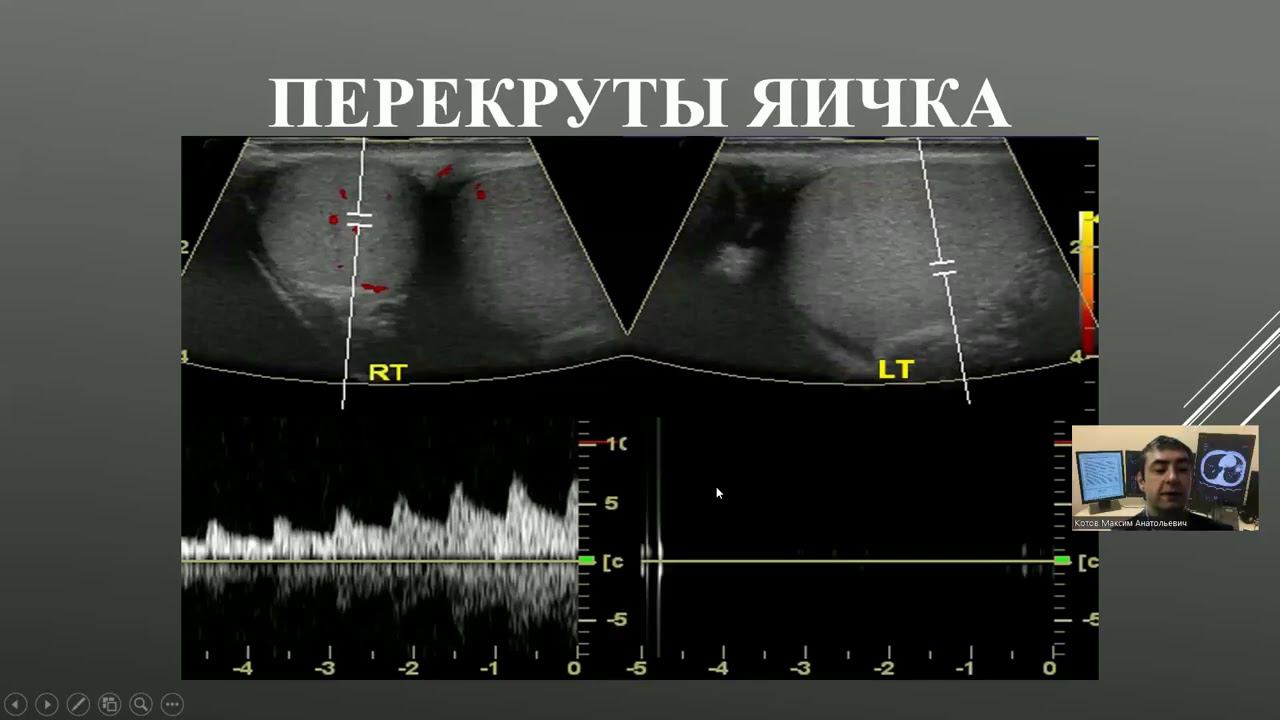 УЗД заболеваний органов мошонки  Часть 1