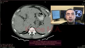 Цирроз печени. Ролик №67